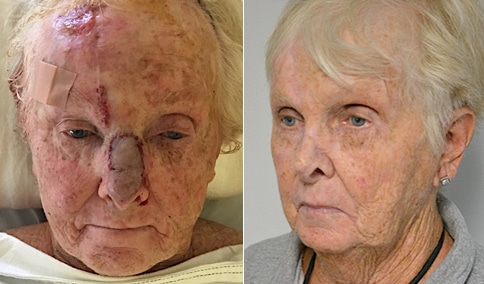 Hall_Boston_Skin-Cancer-Repair-15-Left-OBL3